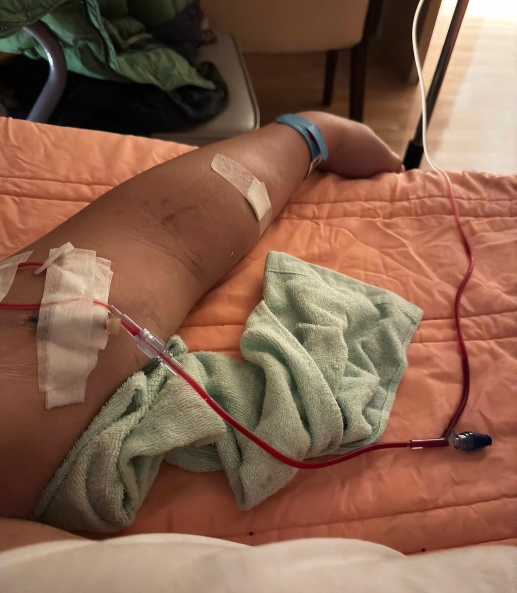 王喜驚爆患上急性腎衰竭。 王喜驚爆患上急性腎衰竭。