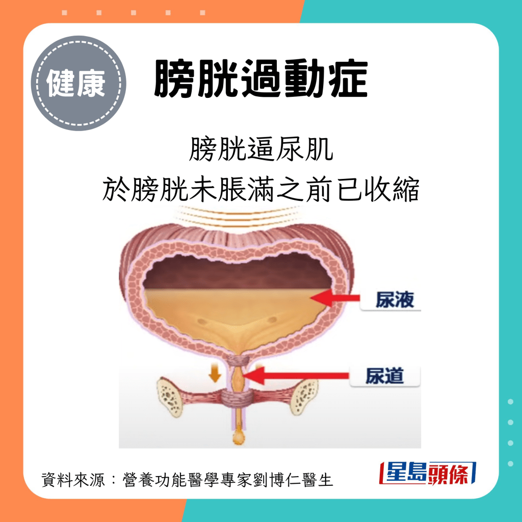 膀胱过动症：膀胱逼尿肌于膀胱未胀满之前已收缩