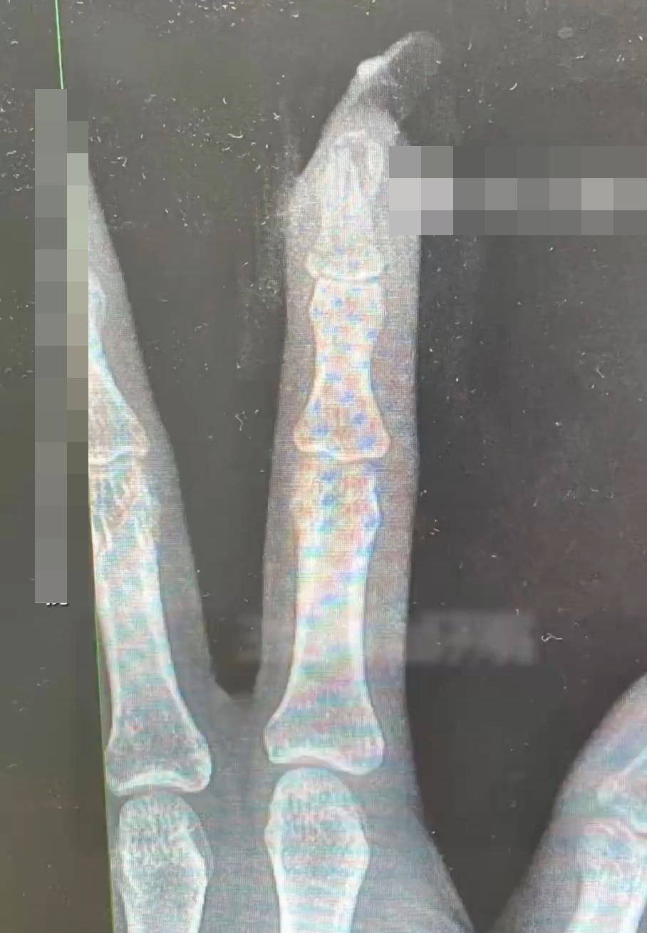 做了美甲後的王女士跌倒，手指骨出現折斷。九派新聞