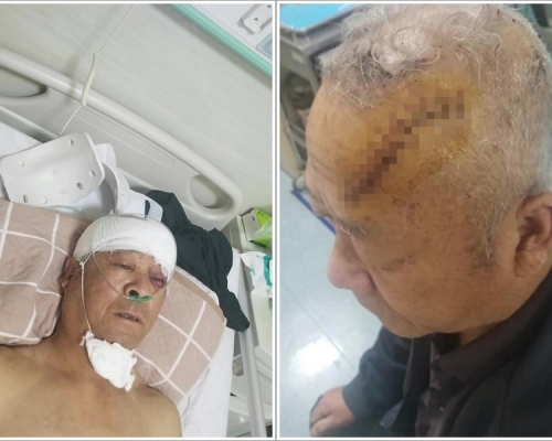 老翁入院縫了11針。網圖