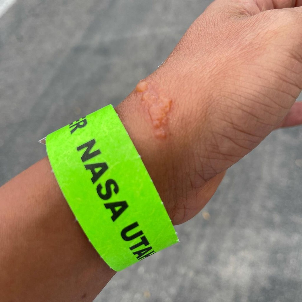 因接觸毒藤引致的過敏性皮炎。