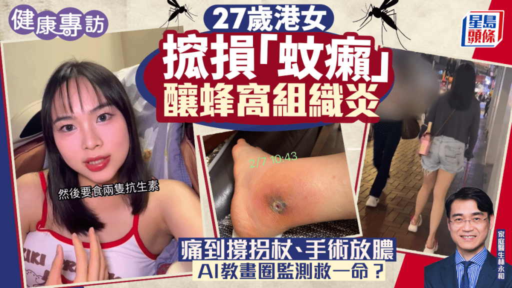 27岁港女搲损「蚊癞」酿蜂窝组织炎 痛到撑拐杖+手术放脓 AI教画圈监测救一命？｜健康专访