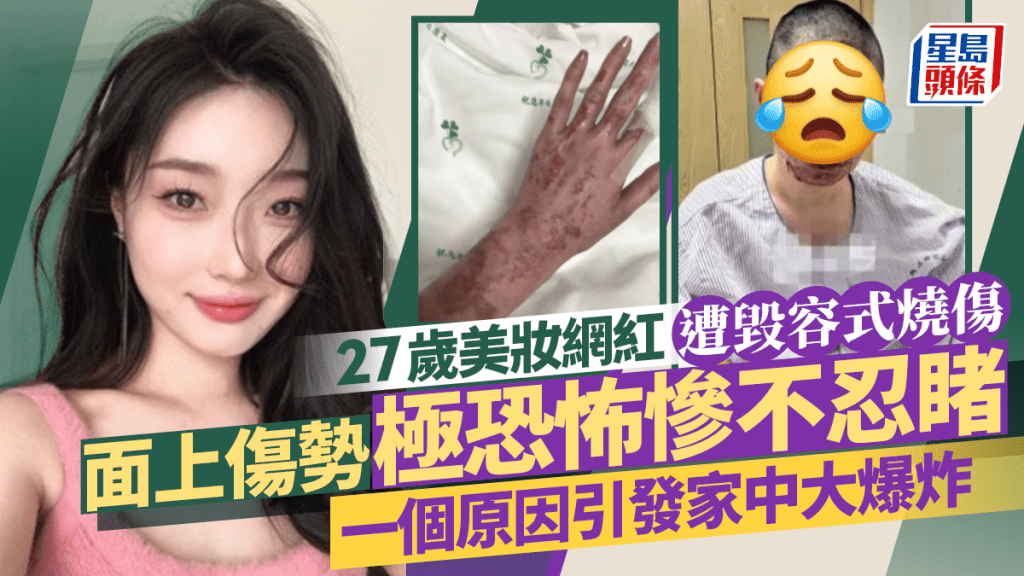 27歲美妝網紅遭毀容式燒傷 面上傷勢極恐怖慘不忍睹 一個原因引發家中氣大爆炸