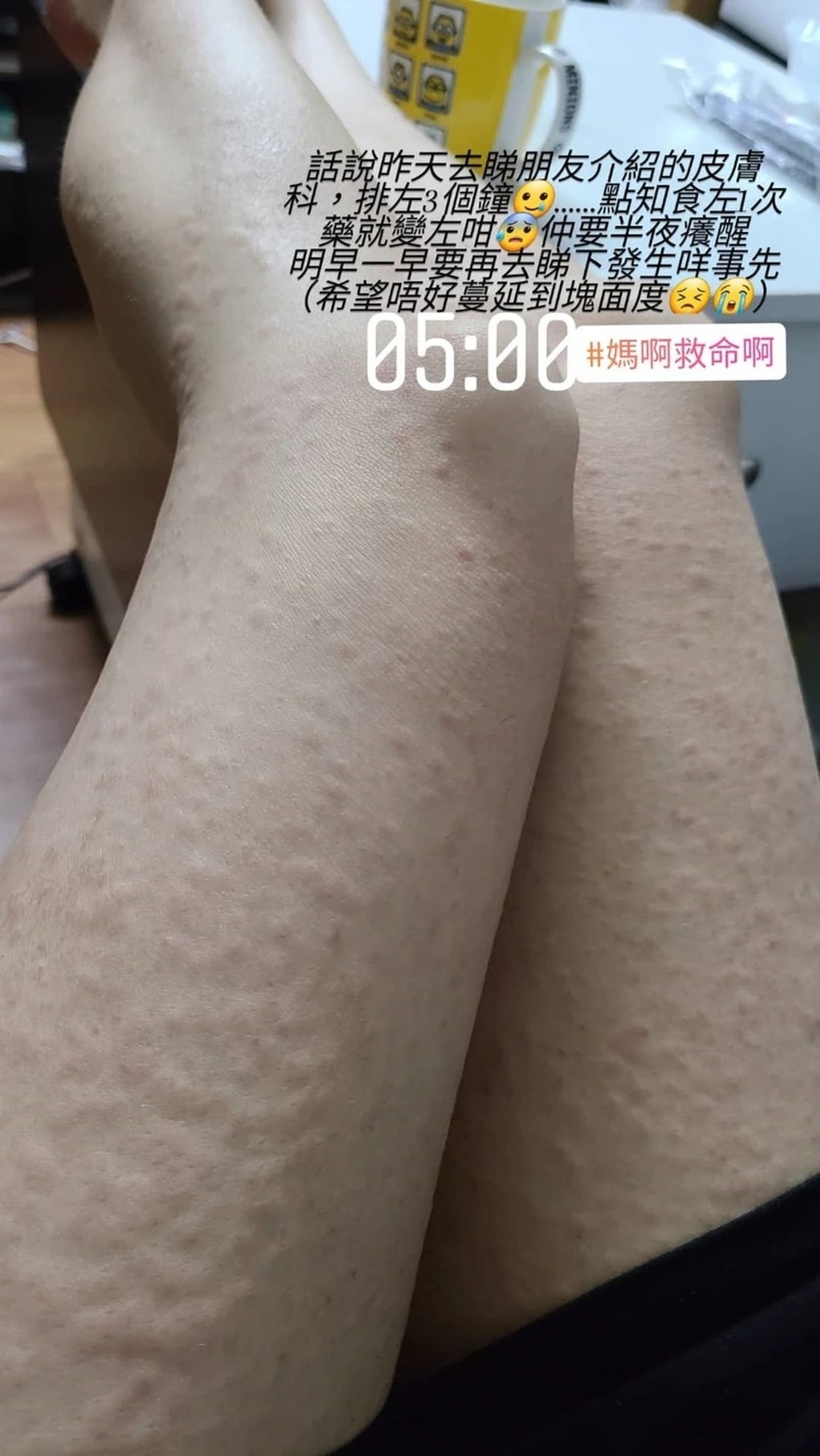 吃药后更双腿长满粒粒。