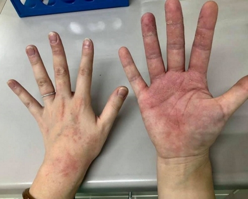 前線抗疫醫護人員雙手長時間戴手套脫皮起紅疹。
