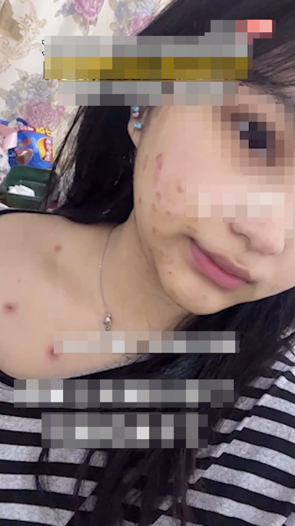 事主被感染貓癬，全身出現紅疹。微博@小莉幫忙