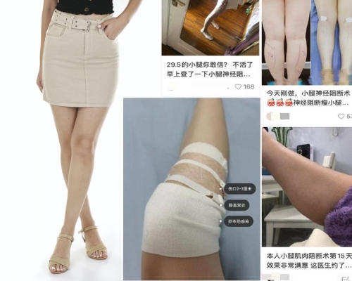 內地女孩為變美腿切斷小腿神經,醫生警告恐致殘。(網圖)
