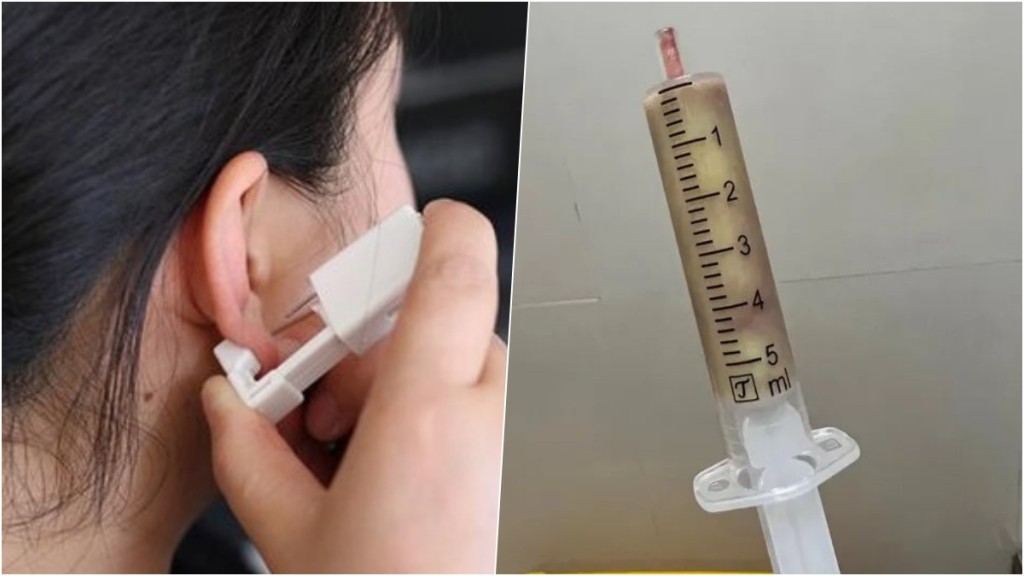 杭州女子買打耳洞神器DIY,結果耳腫如香蕉,抽出一支針筒的膿。 網圖