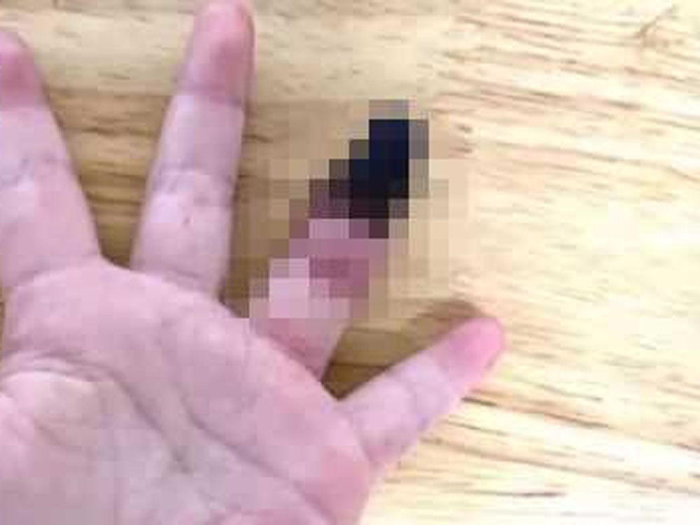 女孩被送到醫院時,她的無名指已經變黑、萎縮。