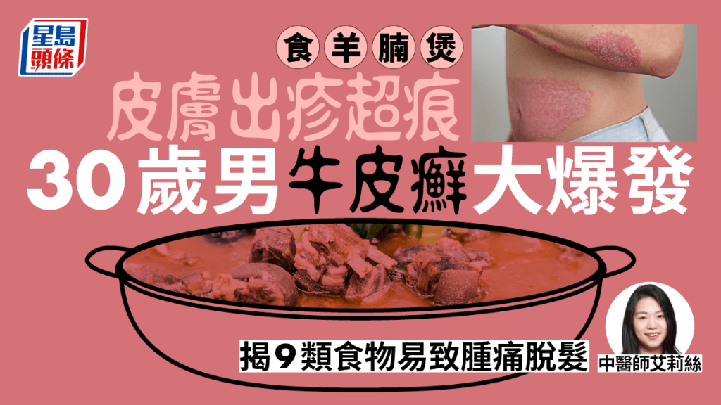 30歲男食羊腩煲出疹極痕癢，中醫指9類食物致牛皮癬爆發恐脫髮。