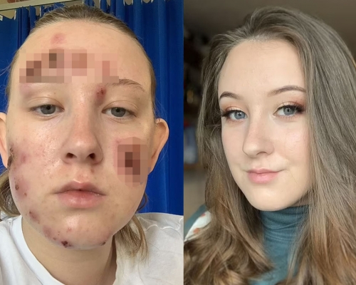 英女臉上生瘡前後對比照。網圖