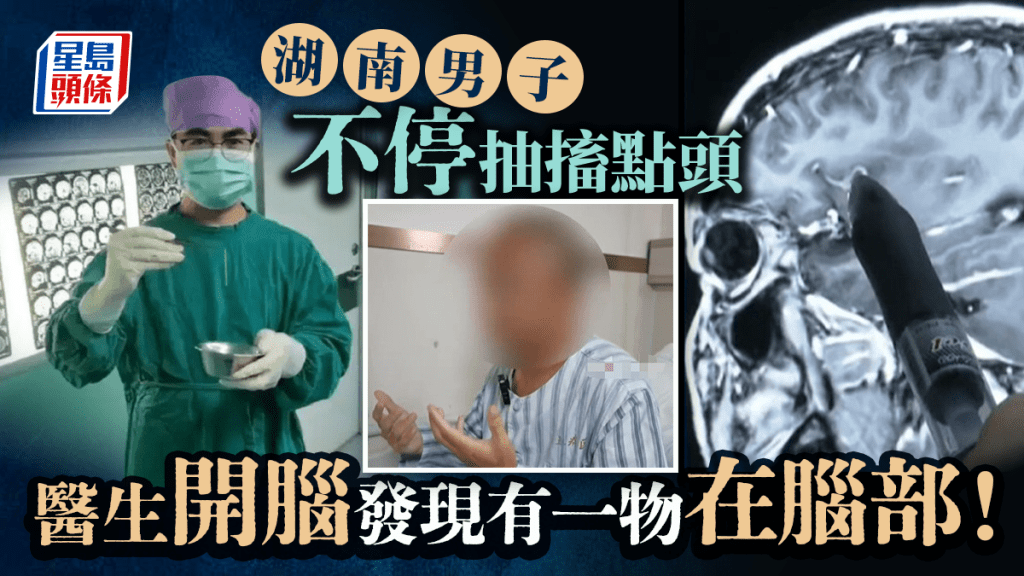 湖南37歲漢突然抽搐失語不停點頭 醫生活捉10厘米活蟲