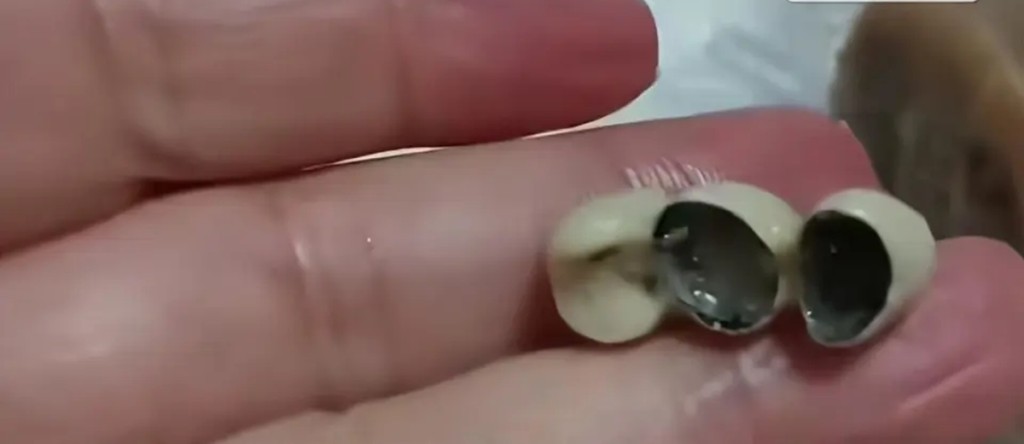 吉林食客香腸吃出三顆相連牙齒。 吉林食客香腸吃出三顆相連牙齒。
