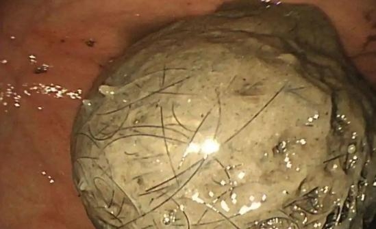 醫療團隊在女童胃中發現大量頭髮形成的胃石。 杭州日報