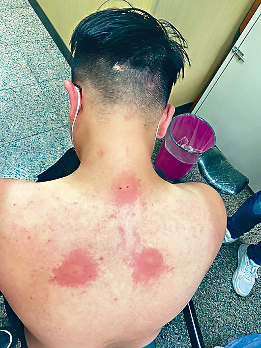 對蜂螫過敏的傷者，皮膚表面會出現紅疹等症狀。