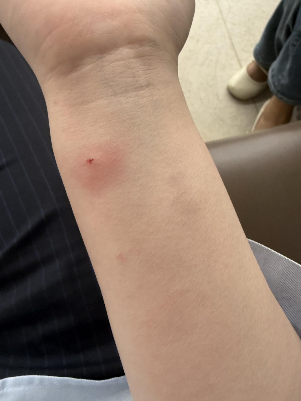 江蘇女子喂微毒的豬鼻蛇被咬，手腫如氣球。抖音