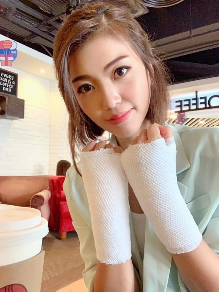 邱芷微本身有類風濕關節炎,手尾相當長。