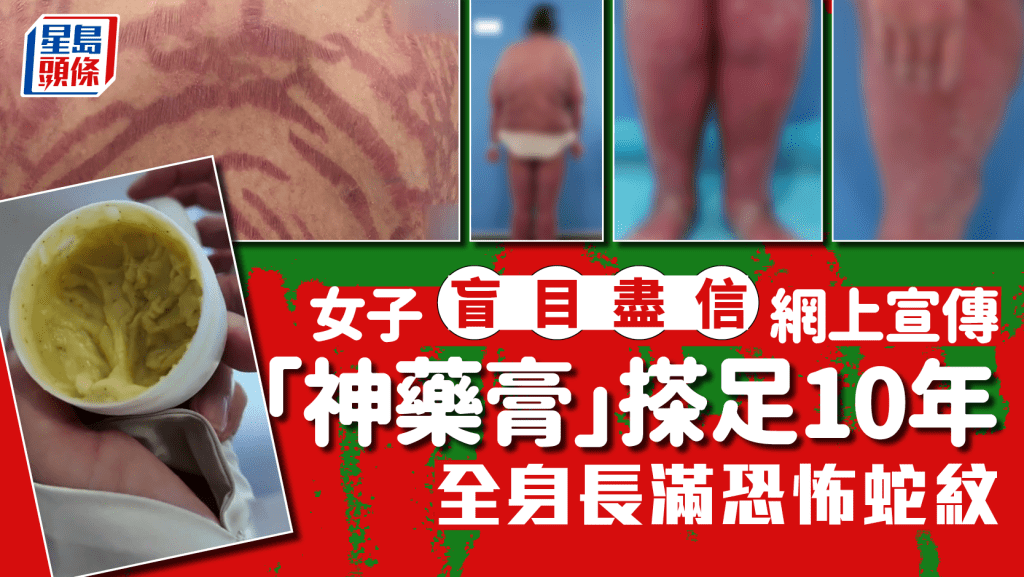 止癢神藥?女子盲塗網紅藥膏10年 全身長滿恐怖蛇紋