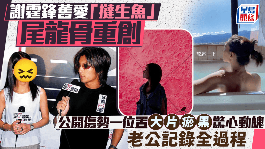 謝霆鋒舊愛「撻生魚」尾龍骨重創  公開傷勢一位置大片瘀黑驚心動魄  老公記錄全過程