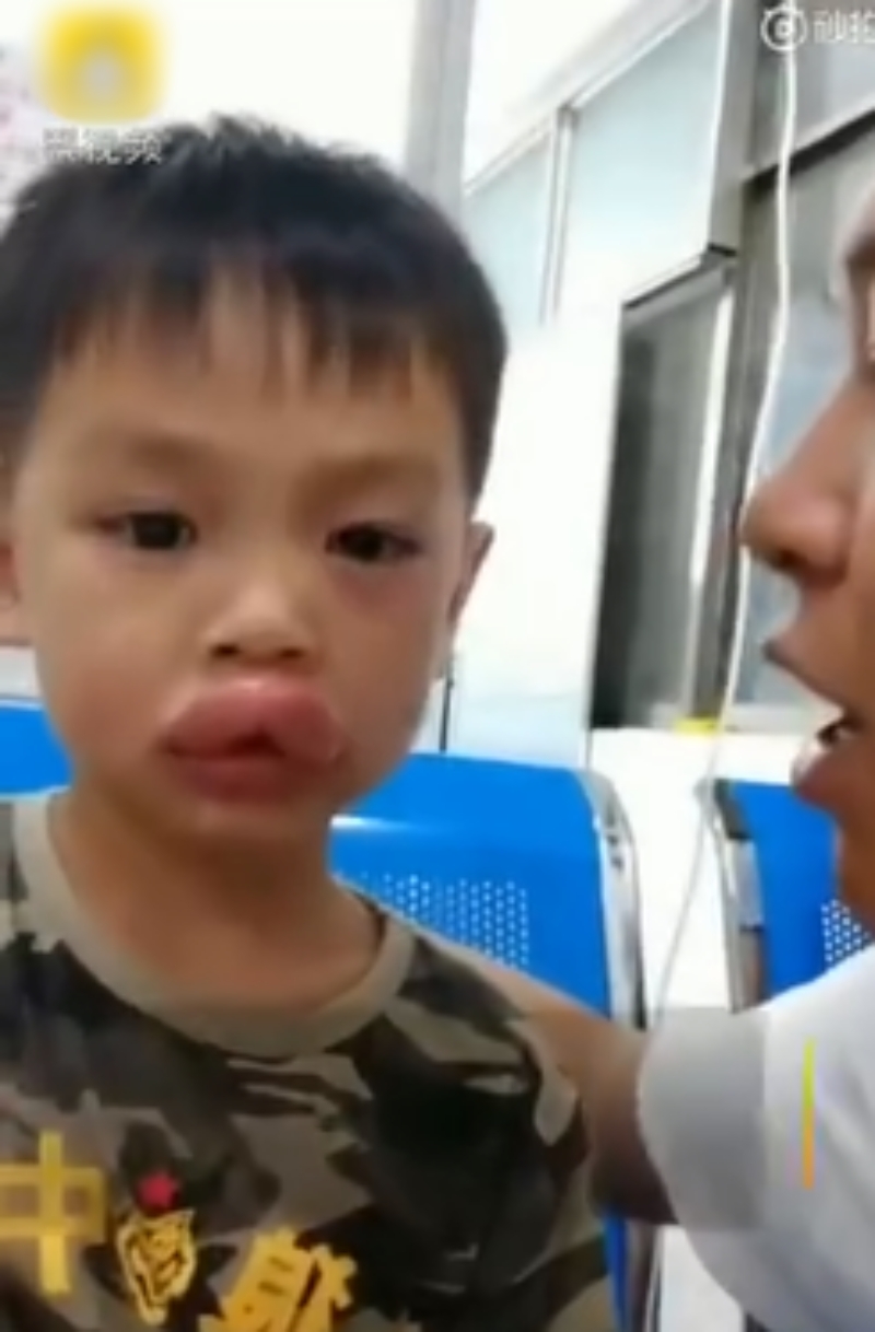 男童進食葡萄後過敏腫成性感「嘟嘟嘴」。網圖