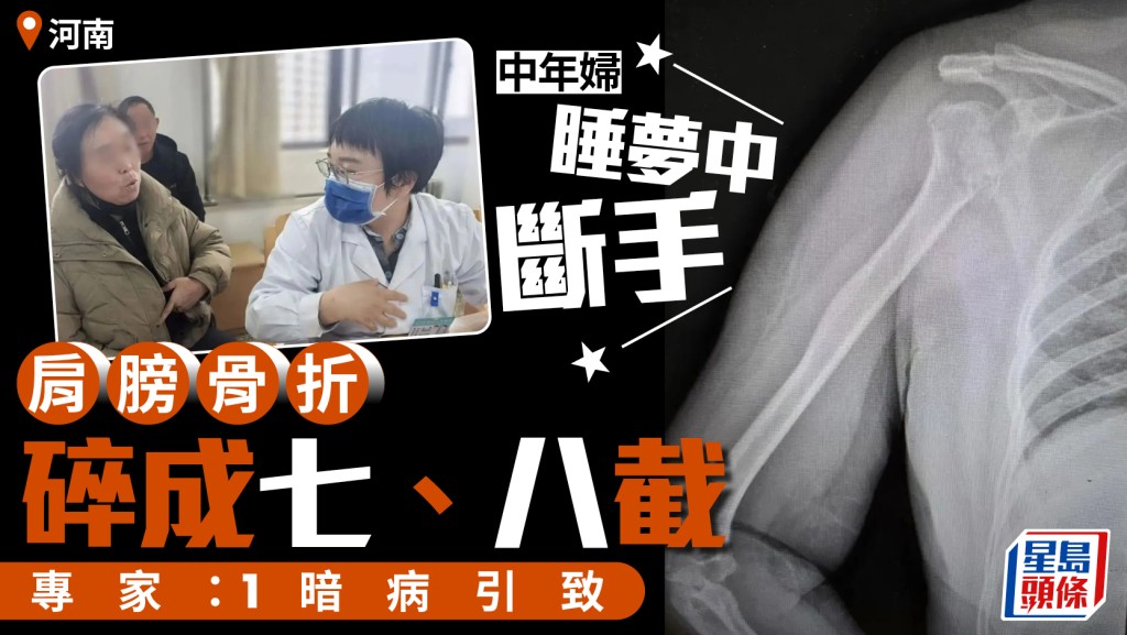 河南中年婦瞓覺變重傷  一種暗病「震碎」手臂骨七、八截
