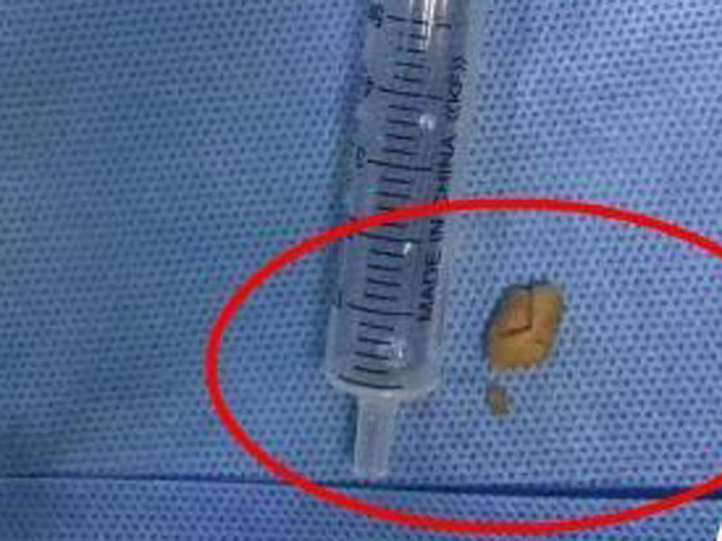 醫護人員前後分了3次才成功將花生連碎等從男童的氣管內取出。(網圖)