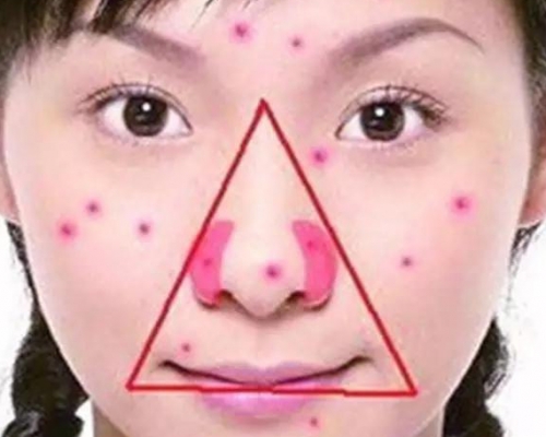 「危险三角区」是指从两侧口角水平至鼻根连线所形成的三角形区域(小图)。 微博图