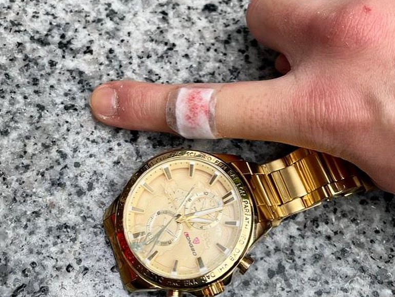 但拍摄时候不小心打爆了杨证桦的手表导致手指流血。