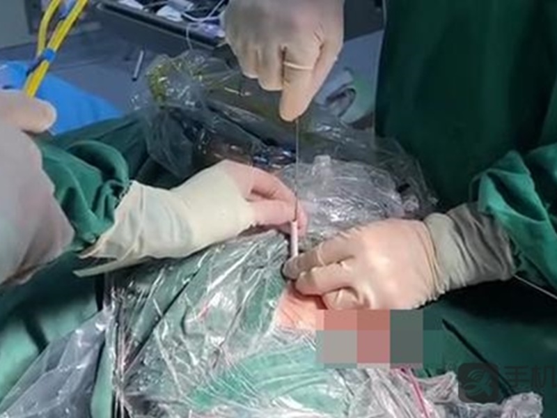 醫生用微創手術將一條長1.5米的電線取出。網圖