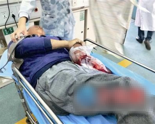 福建漳州一位老翁遭毒蛇咬傷手指,即場自斷手指「保命」。 網上圖片