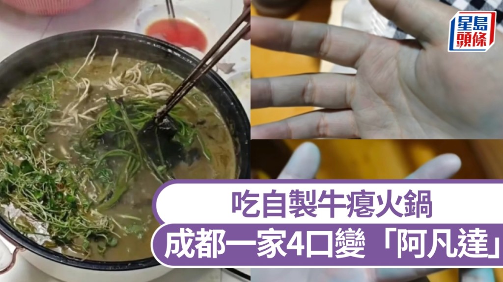 吃自製牛瘪火鍋，成都一家4口雙手變藍中毒送院。