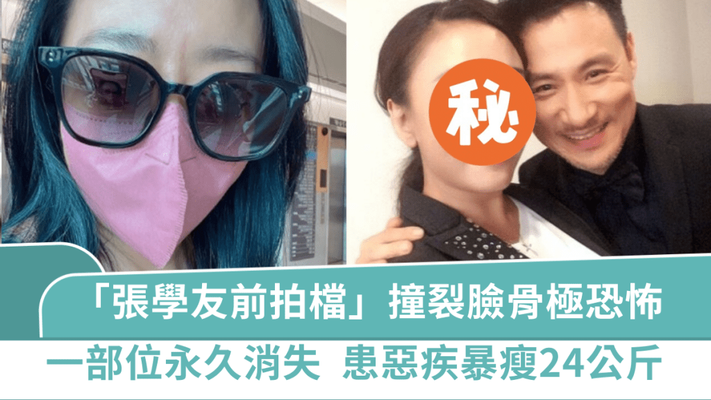 53歲「張學友前拍檔」撞裂臉骨極恐怖  一部位「永久消失」  曾患甲狀腺惡疾暴瘦24公斤