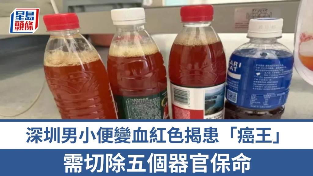 深圳男小便變血紅色揭患胰臟癌，需切除五個器官保命。 第一現場