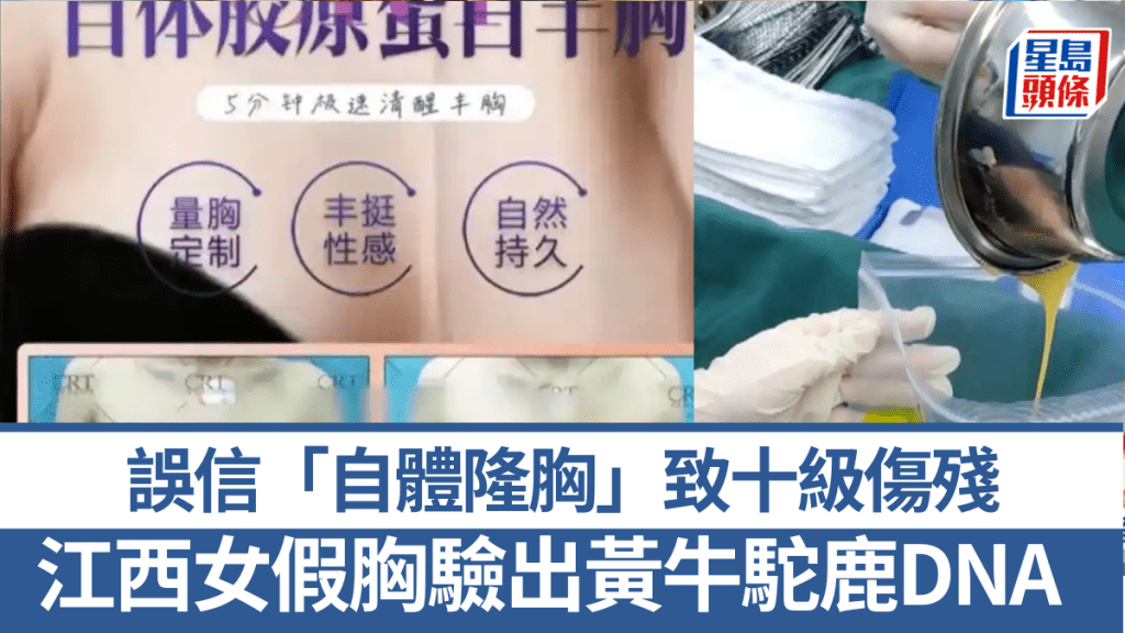江西女花239萬「自體隆胸」致十級傷殘,假胸驗出黃牛駝鹿DNA。