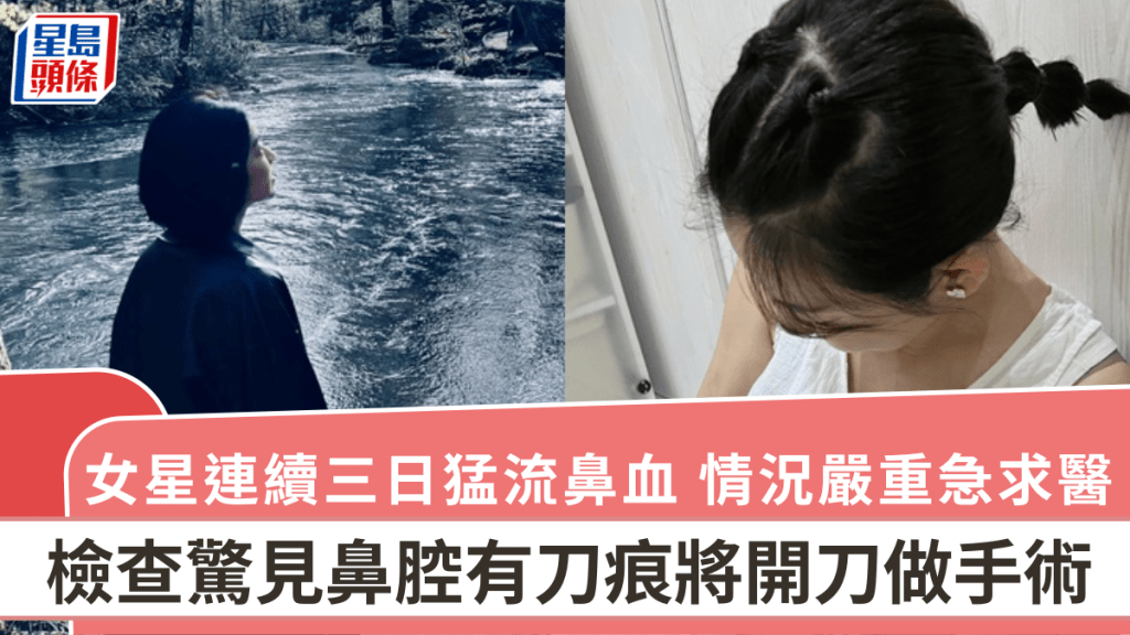 女星連續三日猛流鼻血！情況嚴重急求醫  檢查驚見鼻腔有刀痕將開刀做手術
