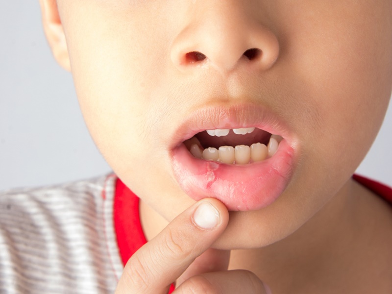 口腔潰瘍俗稱「生痱滋」，即口腔內的黏膜有破皮傷口。網圖（示意圖）