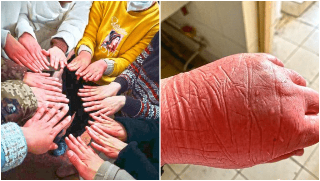 网上流传照片那双手是「白求恩医疗队」护士胡淼（右)。