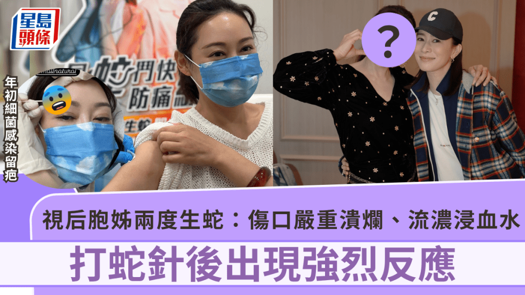 47歲視后胞姊兩度生蛇打蛇針現強烈反應 年初不慎細菌感染延遲診治致額頭疤痕