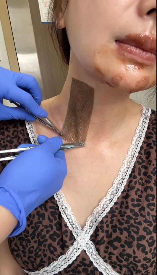 王添羽模仿喷火蛋糕遭回流火焰烧伤。抖音