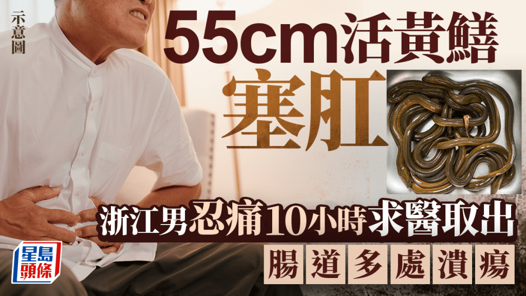 55厘米生猛黃鱔塞肛  浙江漢忍痛逾10小時求醫
