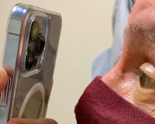 美國有醫生聲稱利用iPhone 13 Pro拍攝病人眼睛情況，有助跟進治療。 網上圖片