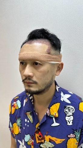 Aaron唔覺尷尬,主動公開早前做植髮手術。