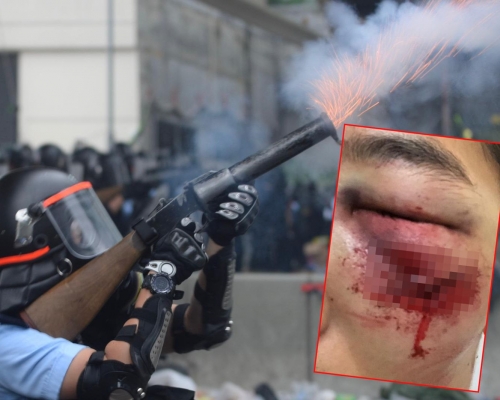 有網民事後在Facebook上傳照片，指朋友被橡膠子彈擦傷面部。
