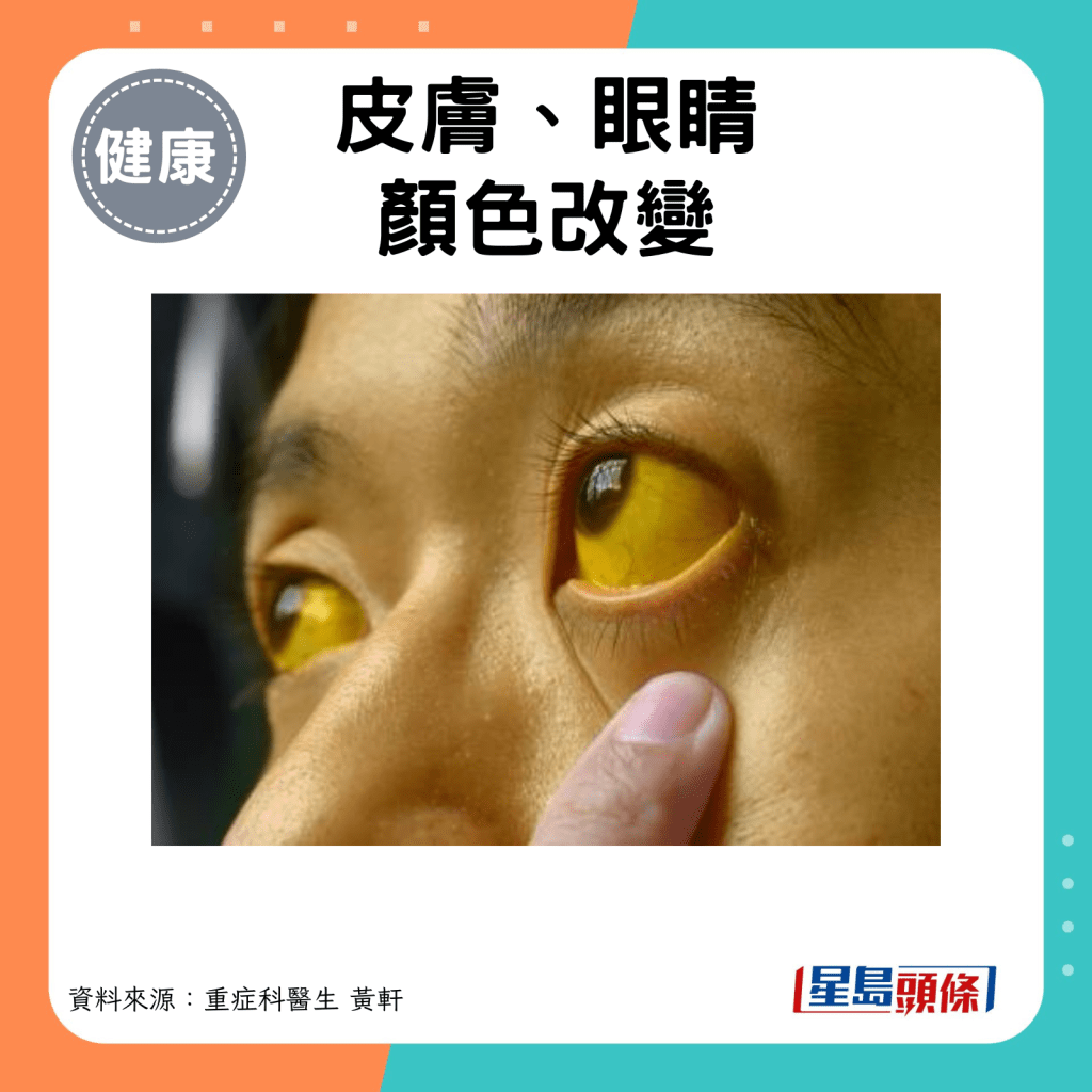 皮膚、眼睛顏色改變。