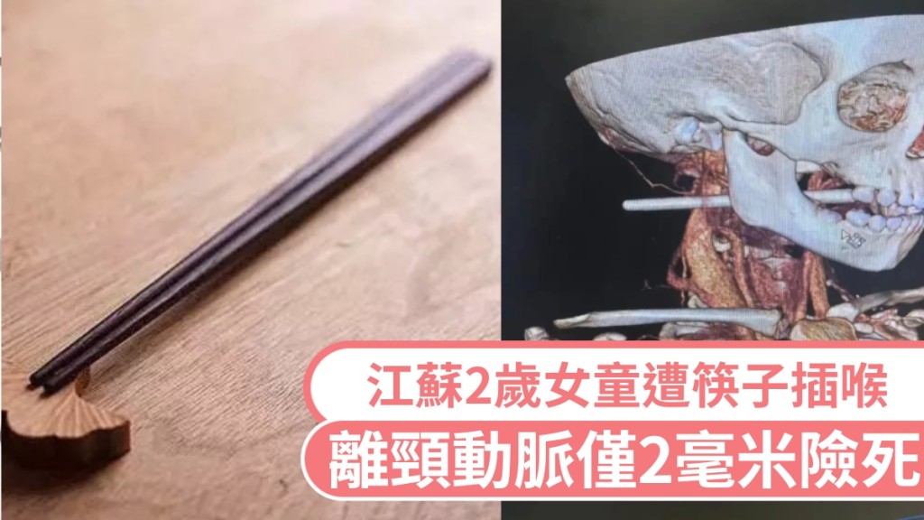 江蘇2歲女童意外遭筷子插喉，離頸動脈僅2毫米險死。 新華社/江蘇新聞廣播