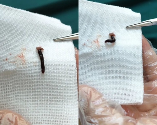 水蛭被夹出后当麻醉药失去效用时，随即回复生气。 网图