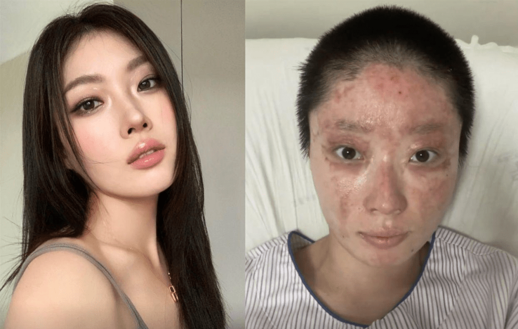 燒傷前後的童瑤。