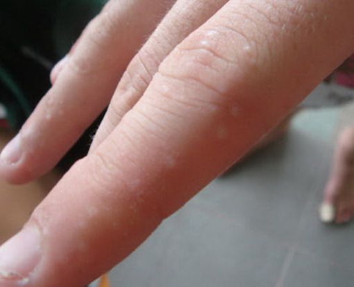 健康Talk】手指起小水泡原來患汗皰疹捱夜壓力大或會引起