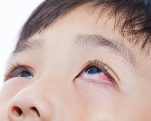 不少人都会习惯性捽眼。网图