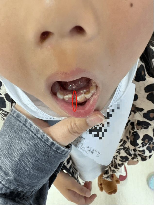 雲南7歲女童恒齒遭錯剝。開屏新聞